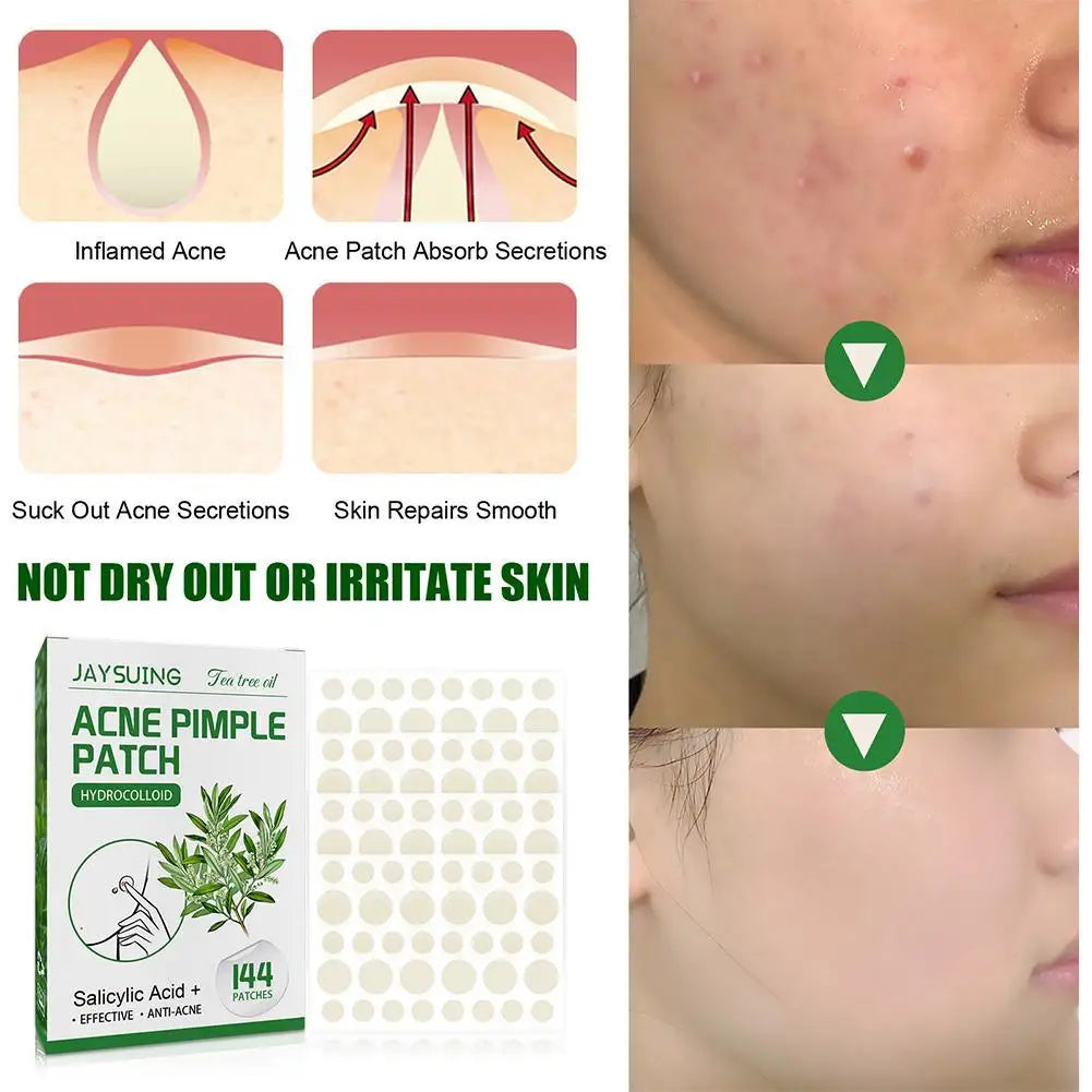 144 Heldere Acne Puistpleisters met Hydrocolloïd, Versterkt met Salicylzuur en Tea Tree Olie om Ontstoken Uitbarstingen te Kalmeren en Witte Punkten te Verbeteren