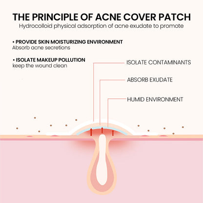 200 Stuks Hydrocolloïde Stervormige Acnepleisters voor Gemakkelijke Blemish Reparatie en Vervaging van Pimple Vlekken
