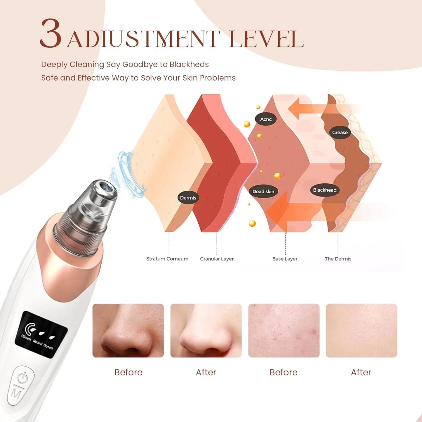 Geavanceerde Zwarte Punt Verwijderaar Vacuüm - Ultieme Porie Reiniger voor Gezicht en Neus - Elektrische Acne Extractie Kit voor Perfecte Huid