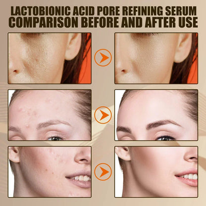 Revitaliseer je huid: Pore-reducerend gezichtserum voor het controleren van mee-eters en acne - Voedende, hydraterende en verstrakkende herstelessence