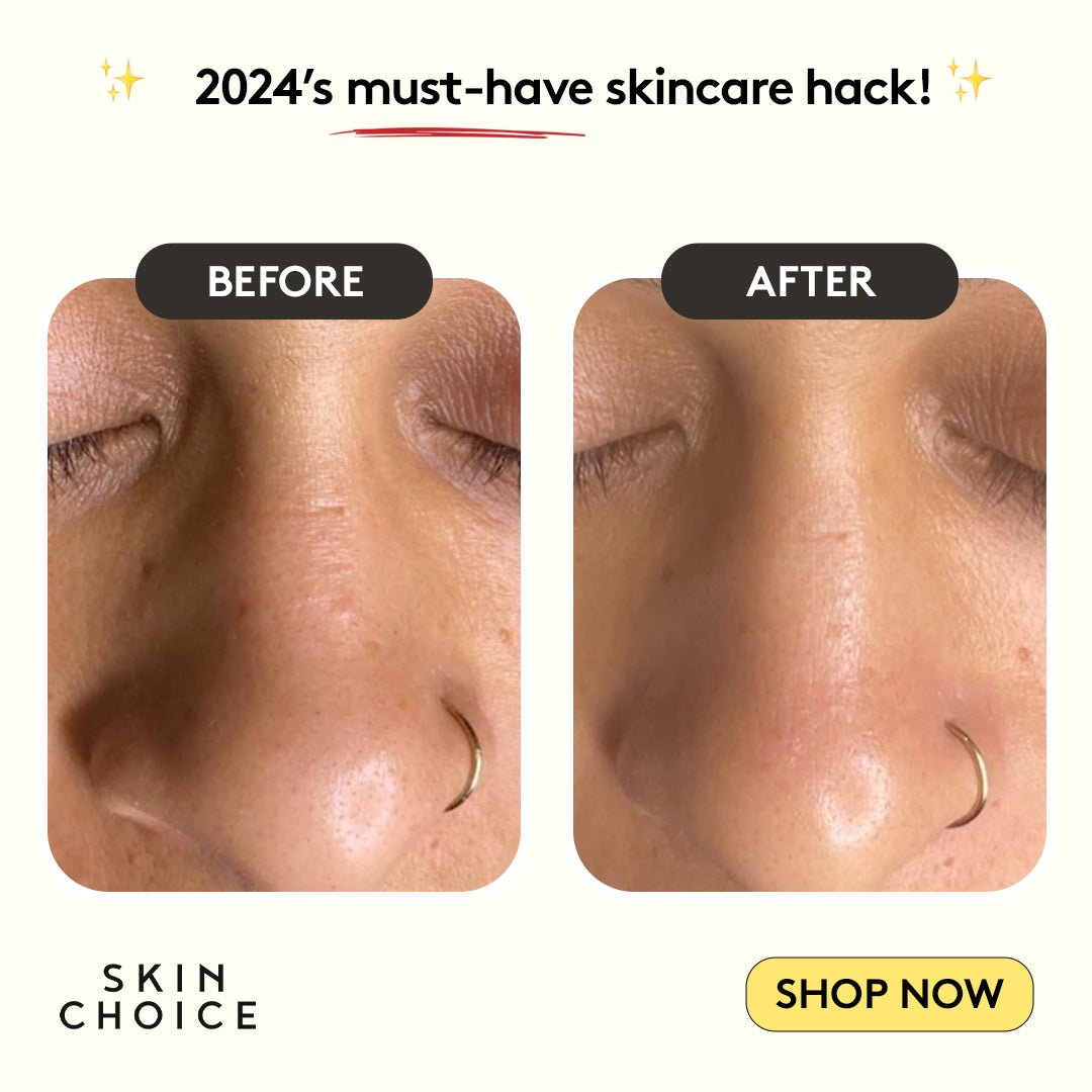 Nose Patches-3