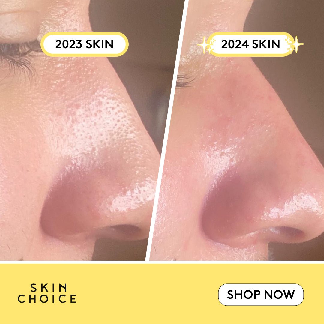 Nose Patches-2